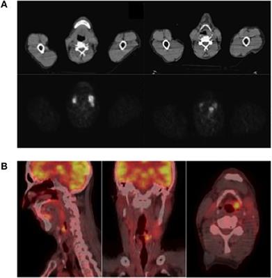 Laryngeal Neuroendocrine Tumor With Elevated Serum Calcitonin: A Diagnostic and Therapeutic Challenge. Case Report and Review of Literature